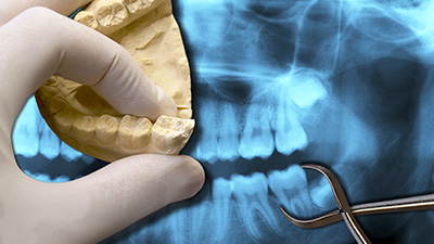 Model smile and x-rays of teeth to be extracted