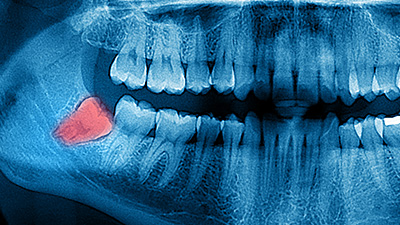 X-ray of impacted wisdom tooth