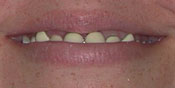 Closeup of woman's smile with stained bonding and crowns