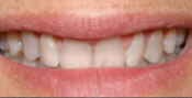 Closeup of smile with tetracycline stains