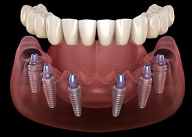 Digital illustration of implant dentures