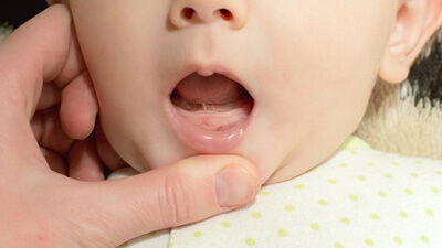 a baby with tomgue tie opening its mouth