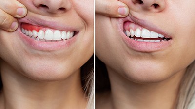 Laser periodontal treatment kills dangerous oral bacteria and protects your teeth and gums