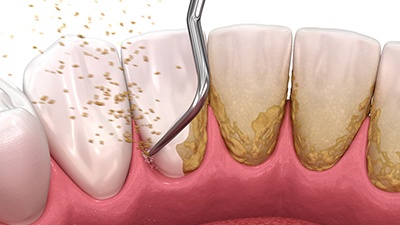 Digital illustration of scaling & root planing