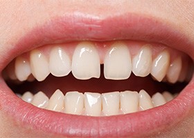 Teeth with gap