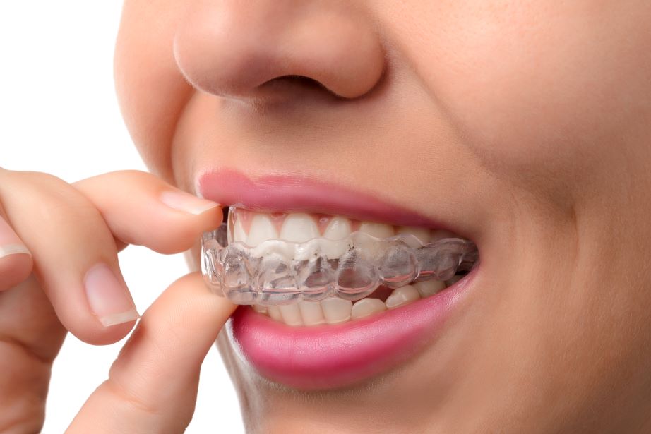 A woman putting on an Invisalign aligner.